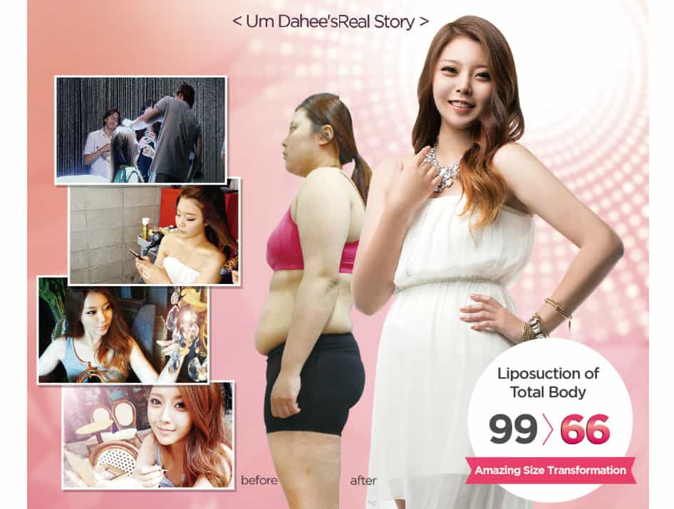 Weight Loss, LIposuction, Cosmetic Surgery, Seoul, South Korea